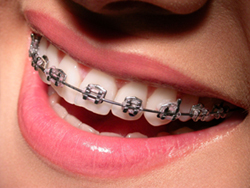 Brackets